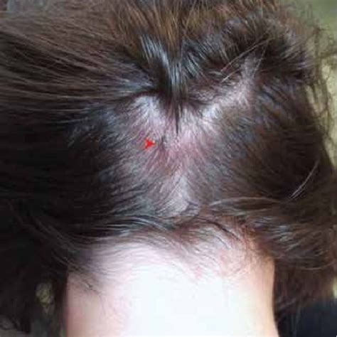 Typical Signs Of Tibola Tick Borne Lymphadenopathydebonel