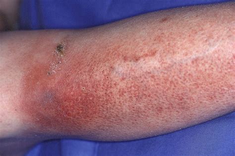 No Single Optimal Antibiotic Therapy For Cellulitis Identified