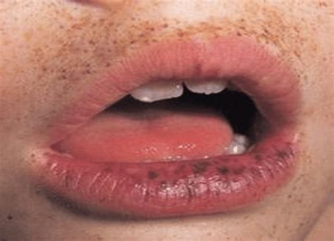 Dark Spots Under Mouth Remove Dark Black Patches Around Mouth In 15