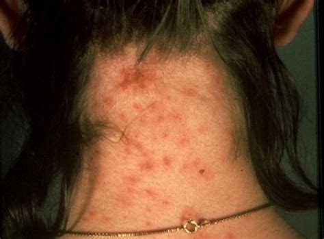 Lice Bites Pictures Identification And Treatment