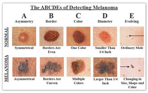 Nodular Melanoma Pictures Symptoms Prognosis Treatment