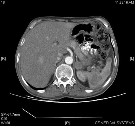 Ct Scan Abdomen Showing Enlarged Lymph Nodes And Splenic Lesions My Xxx Hot Girl
