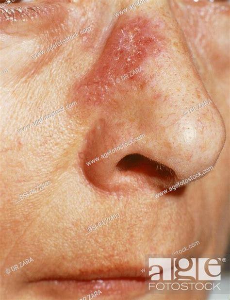 Discoid Lupus Erythematosus Stock Photo Picture And Rights Managed