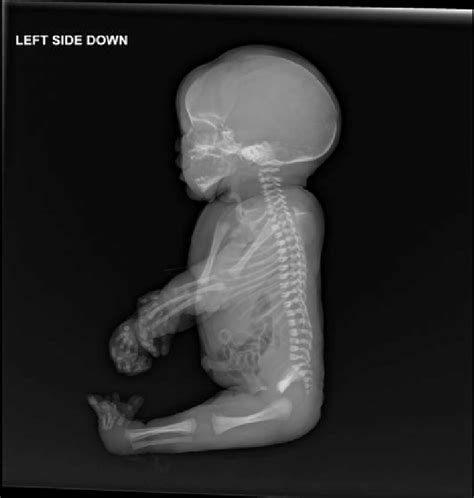Whole Body X Ray Of The Infant Download Scientific Diagram