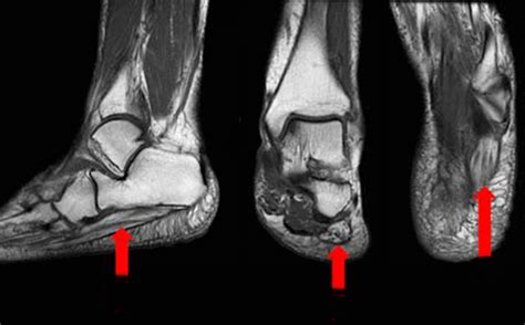 Mri with hardware in foot? Baxter's Nerve Entrapment - Diagnosis, Treatment ...