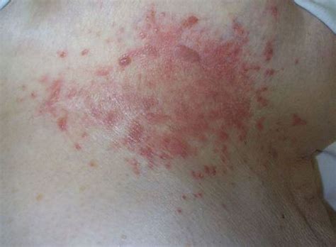 Rash Under Breast Causes Pictures Itchy Treatment Get Rid Treat Md