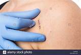 Mole Removal Doctor Or Dermatologist Images