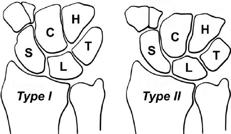 Type I Lunates L Have A Single Distal Facet That Articulates With The Download Scientific