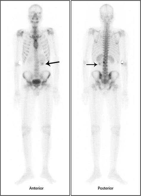 Uptake Of Bone Seeking Radiotracer In The Metastatic Lymph Node From