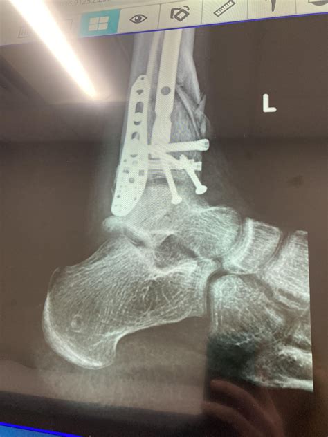 9 Screws And 1 Plate In Ankle From Spiral Pilon Compound Fracture Rxrays