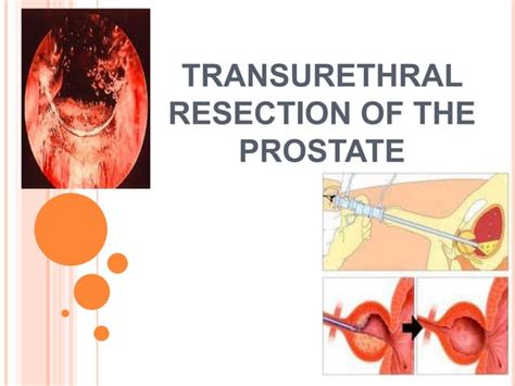 Turp Step By Step Operative Urology