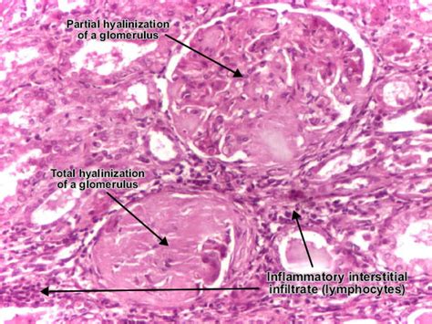 Risk evaluation and screening tests. Patología: RIÑON