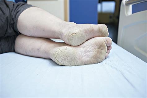 Dry And Cracked Feet In Diabetes Photograph By Lewis Houghtonscience