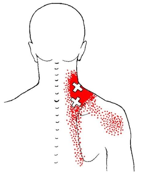 Levator Scapulae Trigger Point Referred Pain Patterns