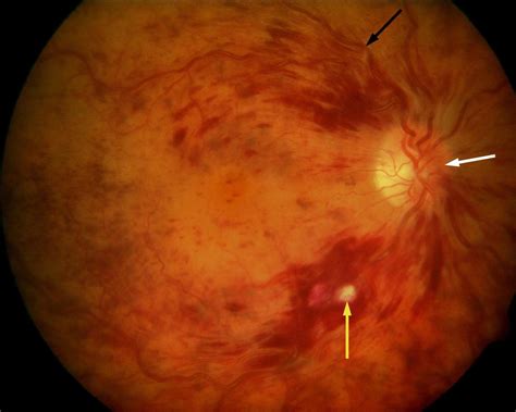 Central Retinal Vein Occlusion Ischaemic In The Right Eye Note The