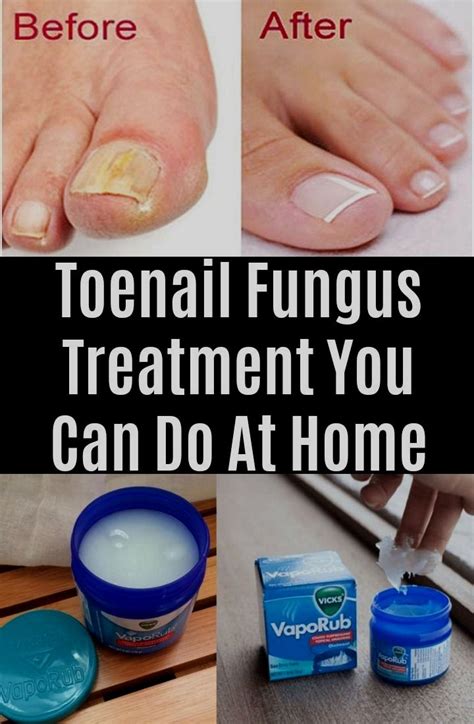 Best Fungal Nail Cure A Comprehensive Guide In 2023