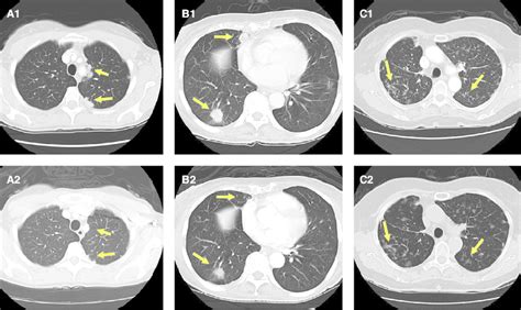 A1 Baseline Chest Ct Of The Fi Rst Patient With Trim33 Ret Showing