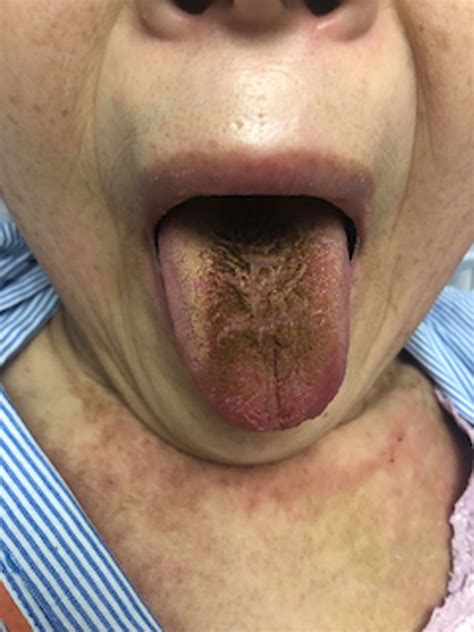 A Blackish Discoloration On The Central Part Of The Dorsal Tongue In