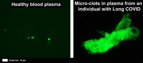 Overload Of Inflammatory Molecules “trapped” In Micro Blood Clots May