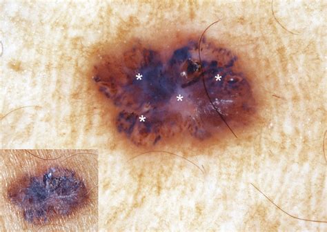 A mole that has increased in size is not necessarily cancerous. Is Your Mole Cancerous?