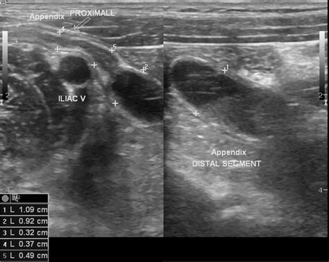 Appendicitis Ultrasound Radiopaedia Details Of The Image Modality