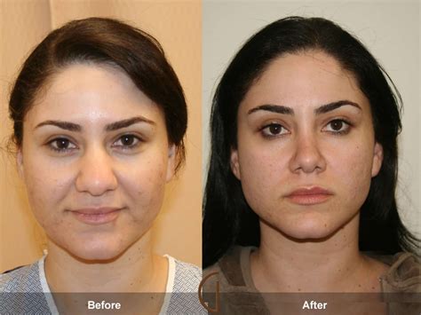 Rhinoplasty Nose Surgery Rolling Hills Estates Ca Before After Photo