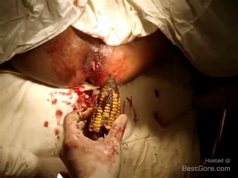 Ear Of Maize Removed By Doctors From A Persons Anus