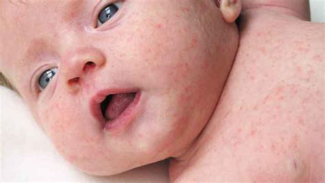 Sarpullido Por Calor En Bebés Qué Es Causas Principales Síntomas Y Tratamiento Dijelaskan