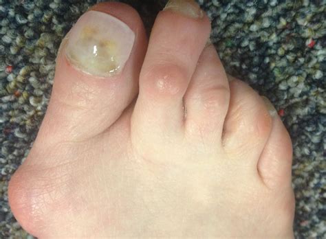 Bunion Surgery - Seattle, WA Foot Doctor