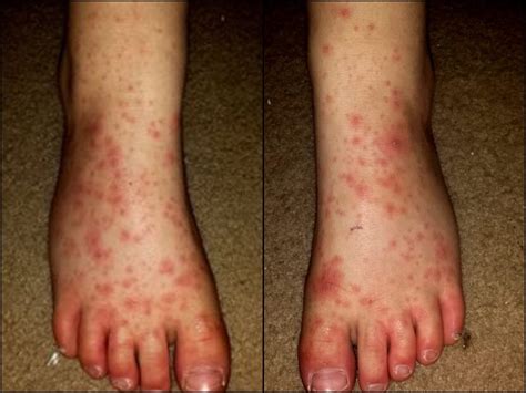 Hand Foot And Mouth Disease Reported Forums