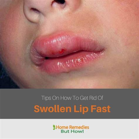 Tips On How To Get Rid Of A Swollen Lip Fast Home Remedies But How
