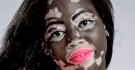 Self Conscious Nurse With Vitiligo Skin Condition Becomes