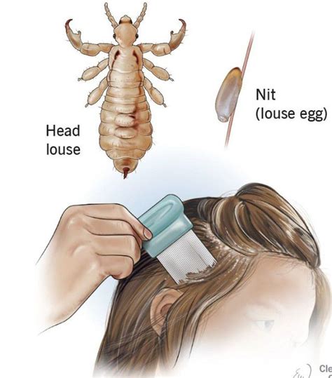 Head Lice And Nits Medizzy