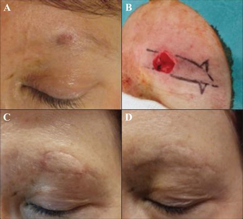 Jle European Journal Of Dermatology Clues In Skin Surgery Island