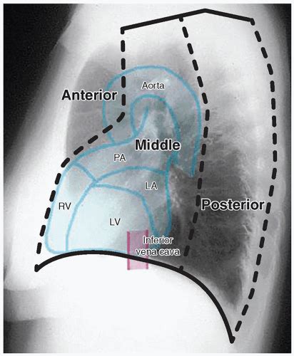 Mediastinum Radiology Key
