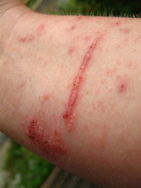 Poison Ivy Rash On My Arm Vilseskogen Flickr