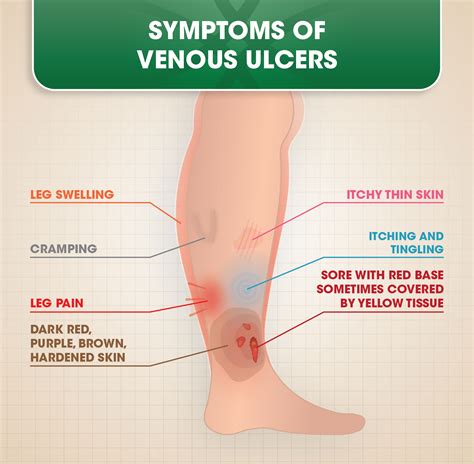 Venous ulcers develop from damage to the veins caused by an insufficient return of blood back to. Venous Ulcers | DOC Vein Management