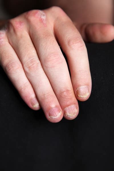 Psoriasis On Hand Includes Psoriasis On The Palm Knuckles Wrist And