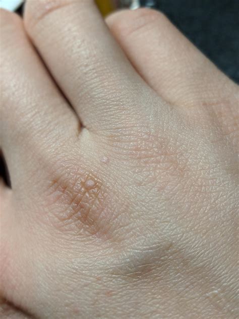 Is This Common Warts My Fingers Have Been Feeling Itchy On The Inside