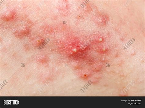 Nodular Cystic Acne Image And Photo Free Trial Bigstock