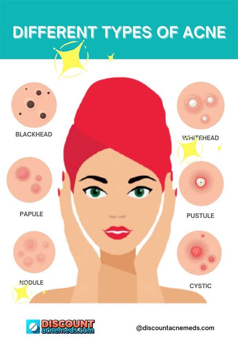 Different Types Of Acne Different Types Of Acne Types Of Acne Acne