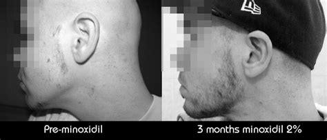 Applied kirkland minoxidil 5% for around 18 months. Minoxidil (or Rogaine) Works for Beard Growth: Fact or Myth?