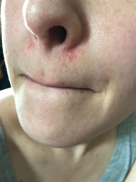 Skin Concerns Redness Irritation Near The Base Of Nose What Does