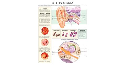 Otitis Media E Chart Full Illustrated By HC HealthComm