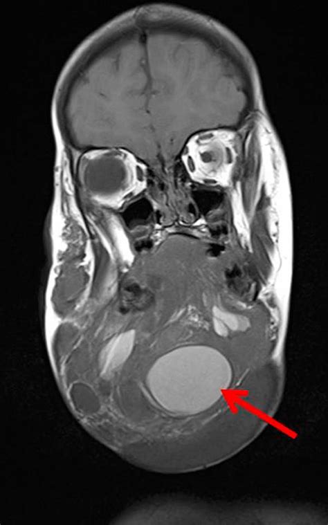 Compva Complications In The Natural Course — Lymphatic Malformation