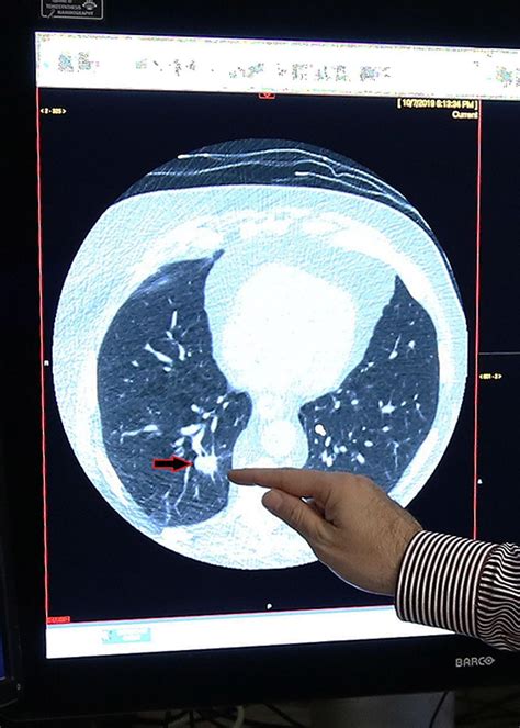 Low Dose Ct Scan Offers Early Detection Of Lung Cancer Westerly