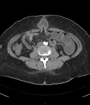 Umbilical Hernia Radiology Reference Article Radiopaedia Org