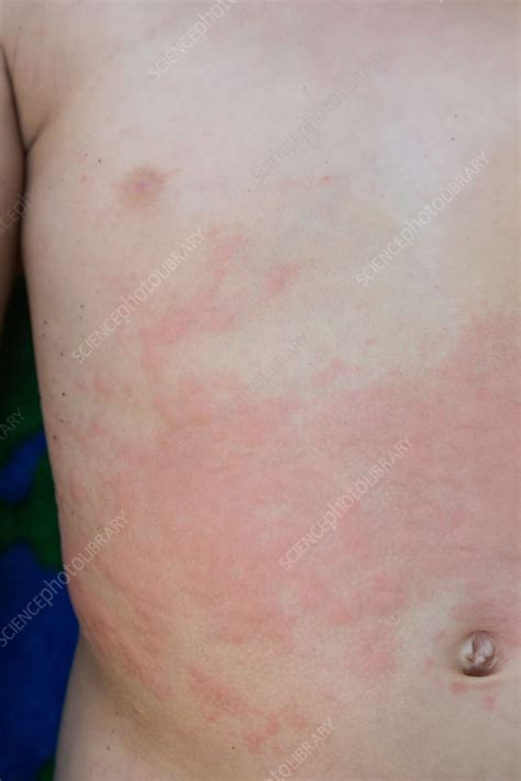 Allergic Rash Stock Image C0351217 Science Photo Library