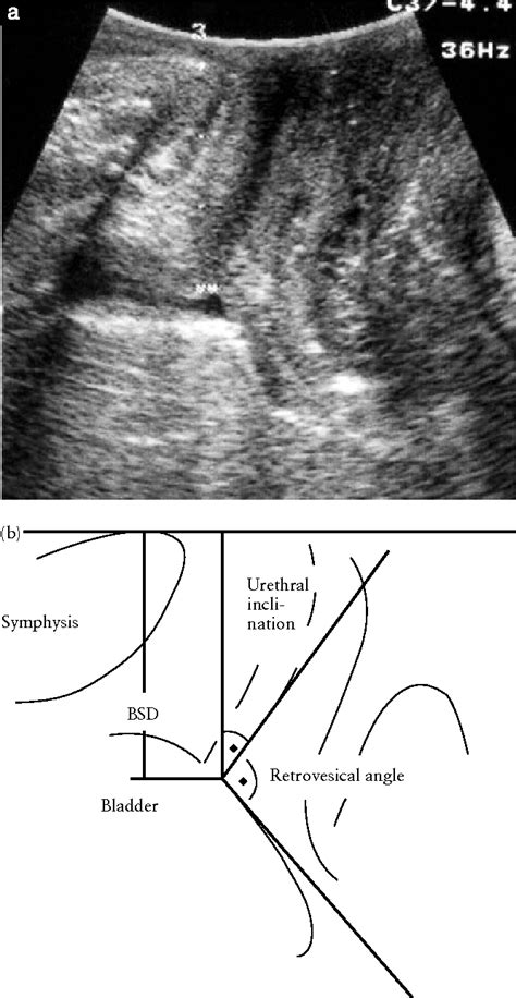 Ultrasound Imaging Of The Pelvic Floor Part I Two Dimensional Aspects