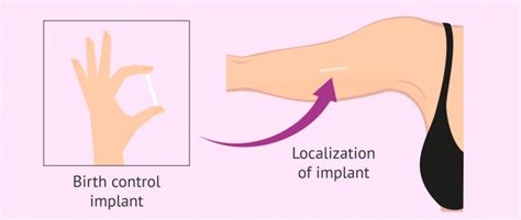 Birth Control Implant Advantages And Disadvantages